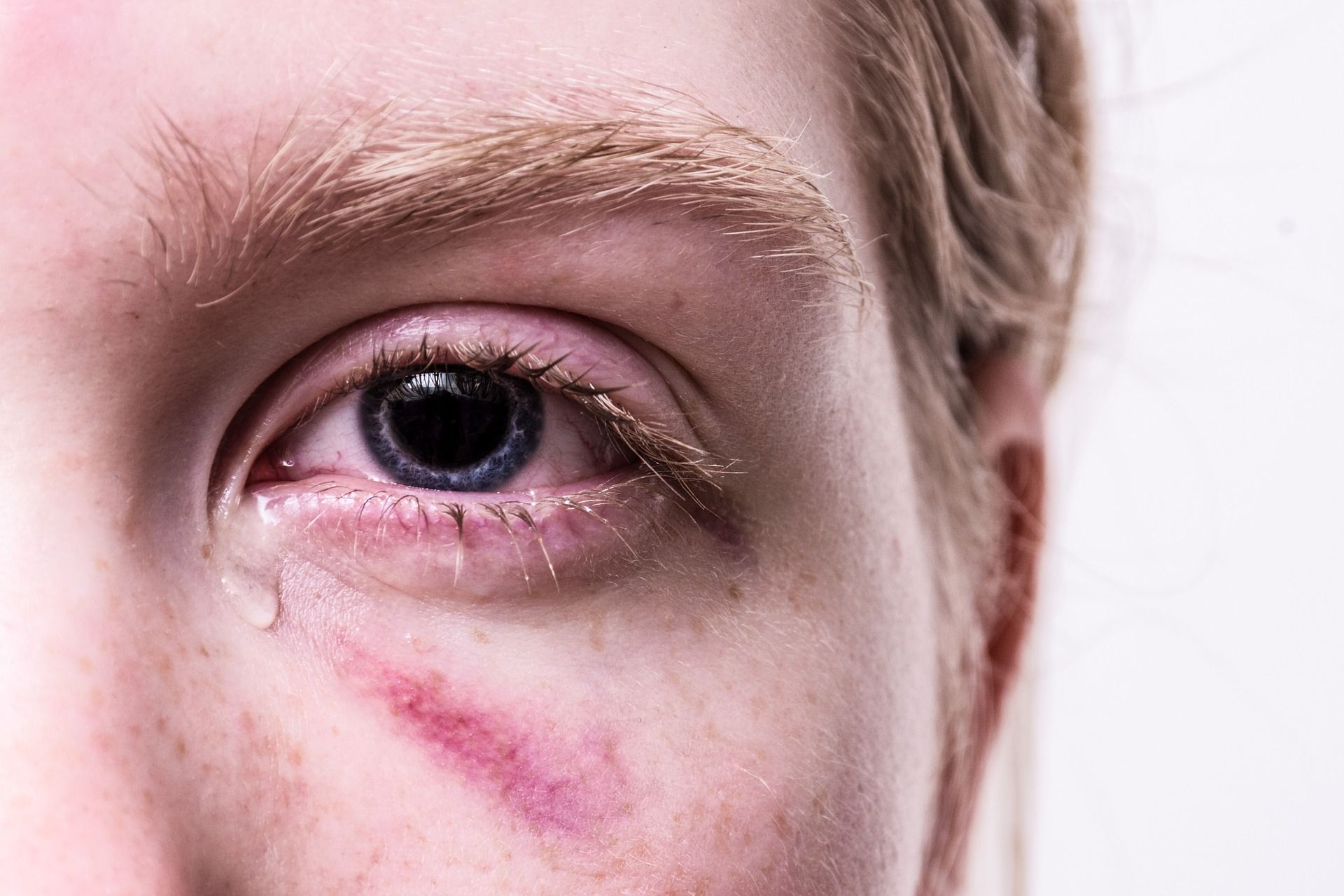 Blaues Auge und Tränen bei einer jungen Frau